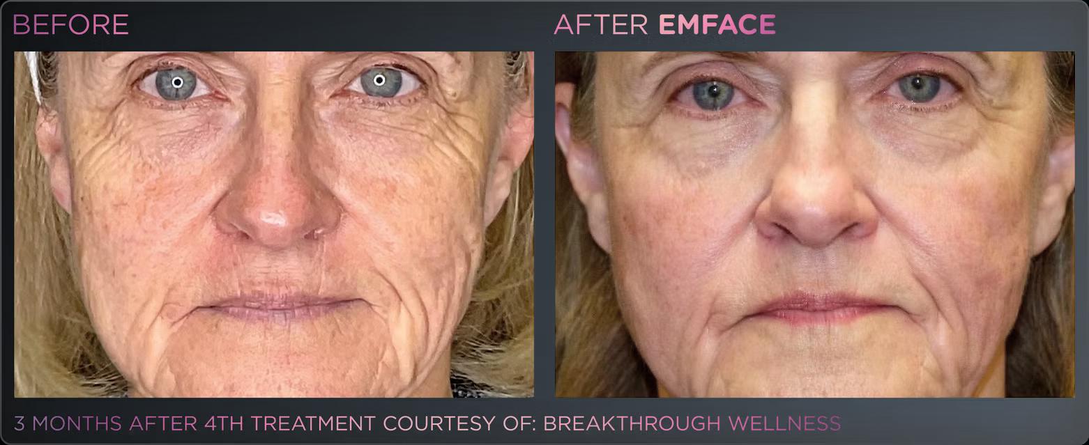 EMFACE before and after result 1