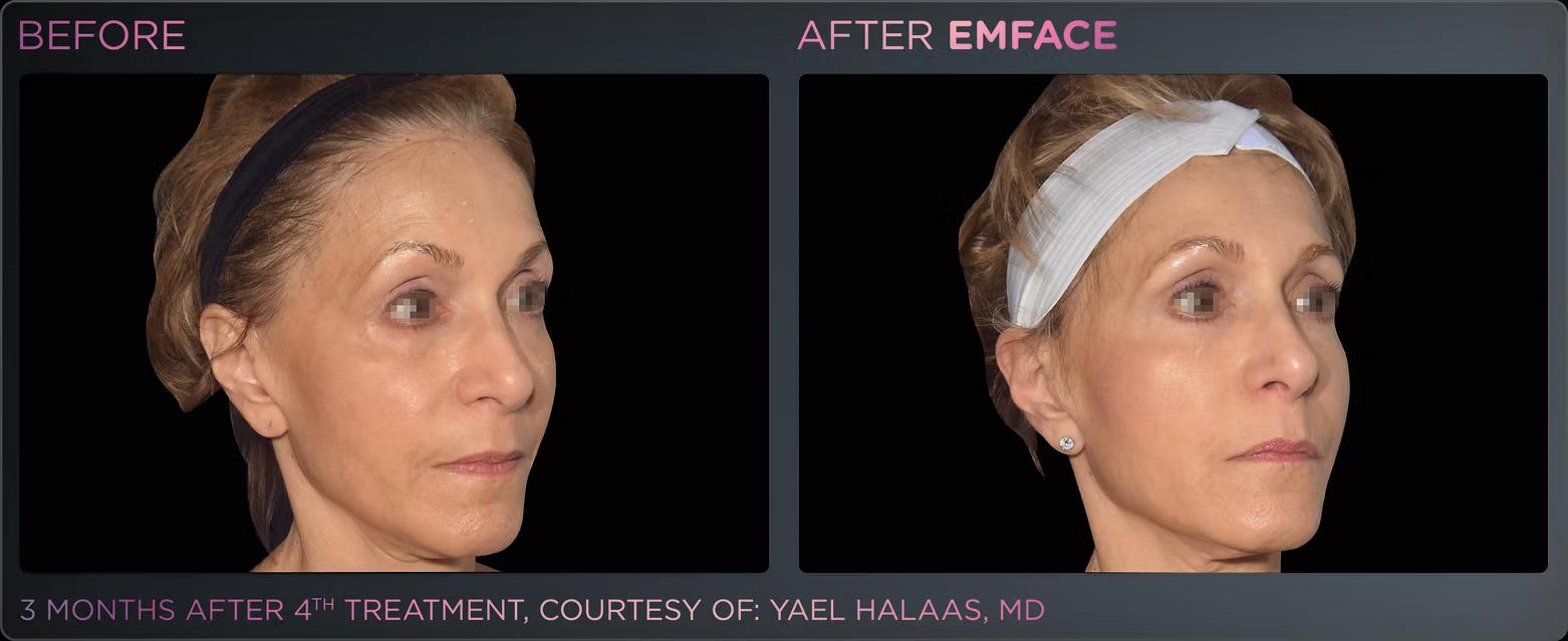 EMFACE before and after result 10