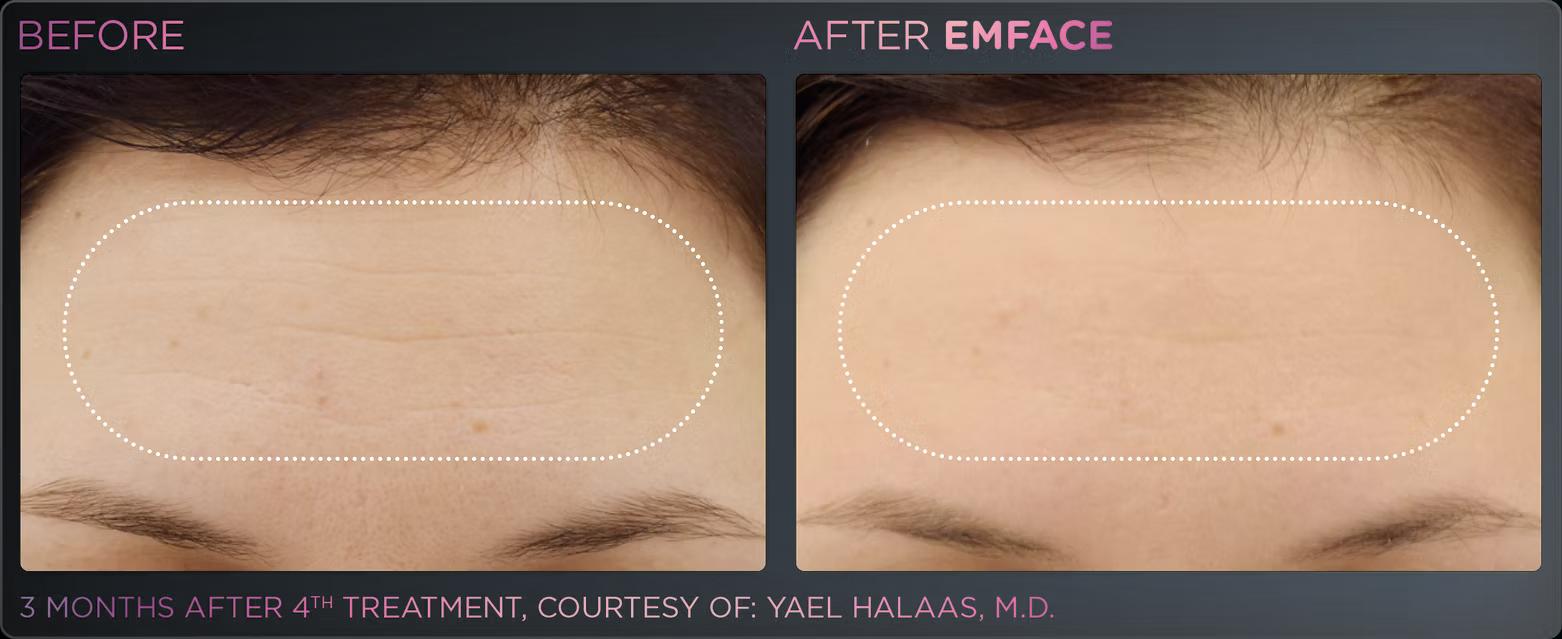 EMFACE before and after result 11