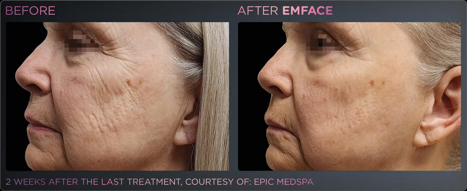 EMFACE before and after result 12