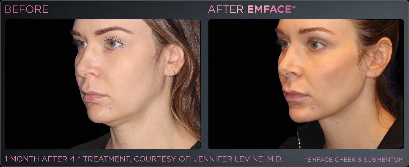 EMFACE before and after result 13