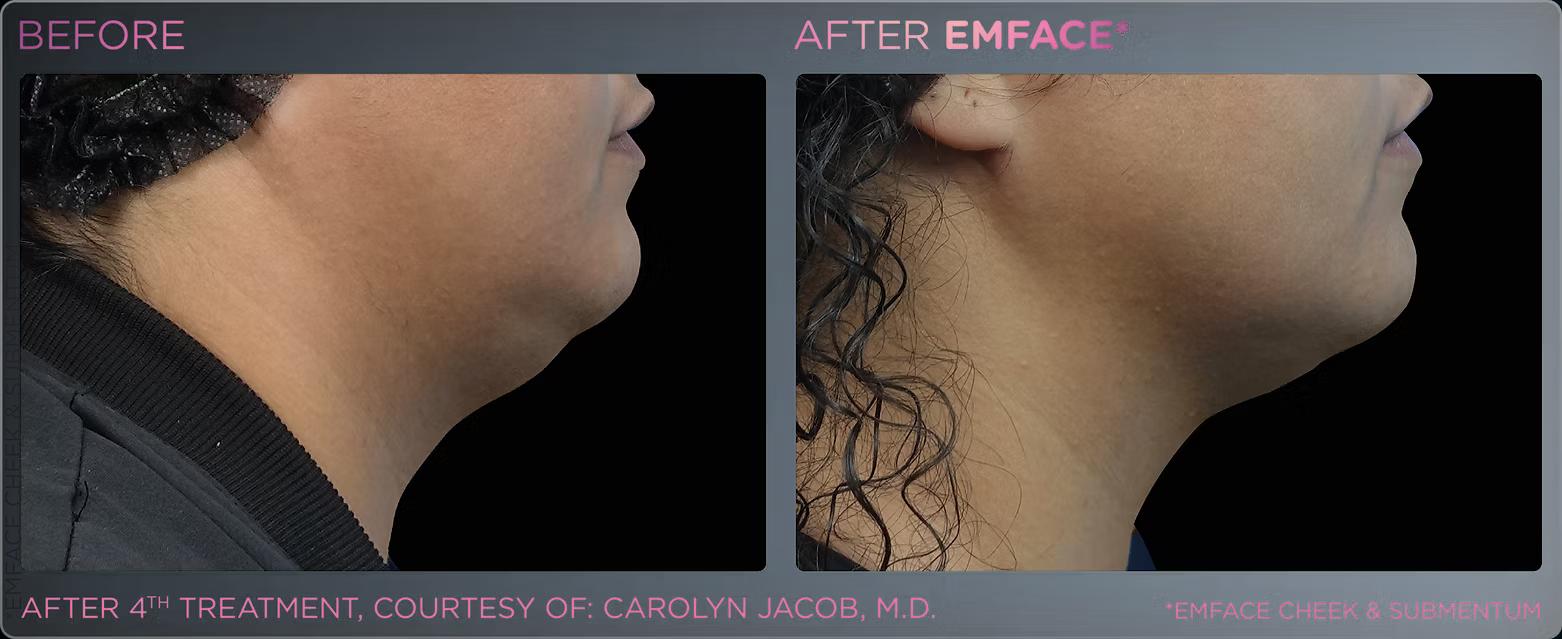 EMFACE before and after result 14