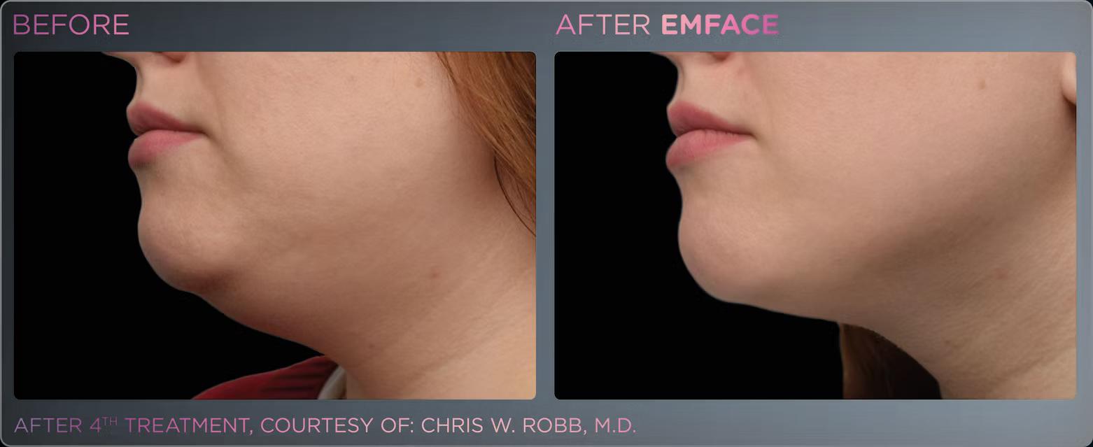 EMFACE before and after result 15