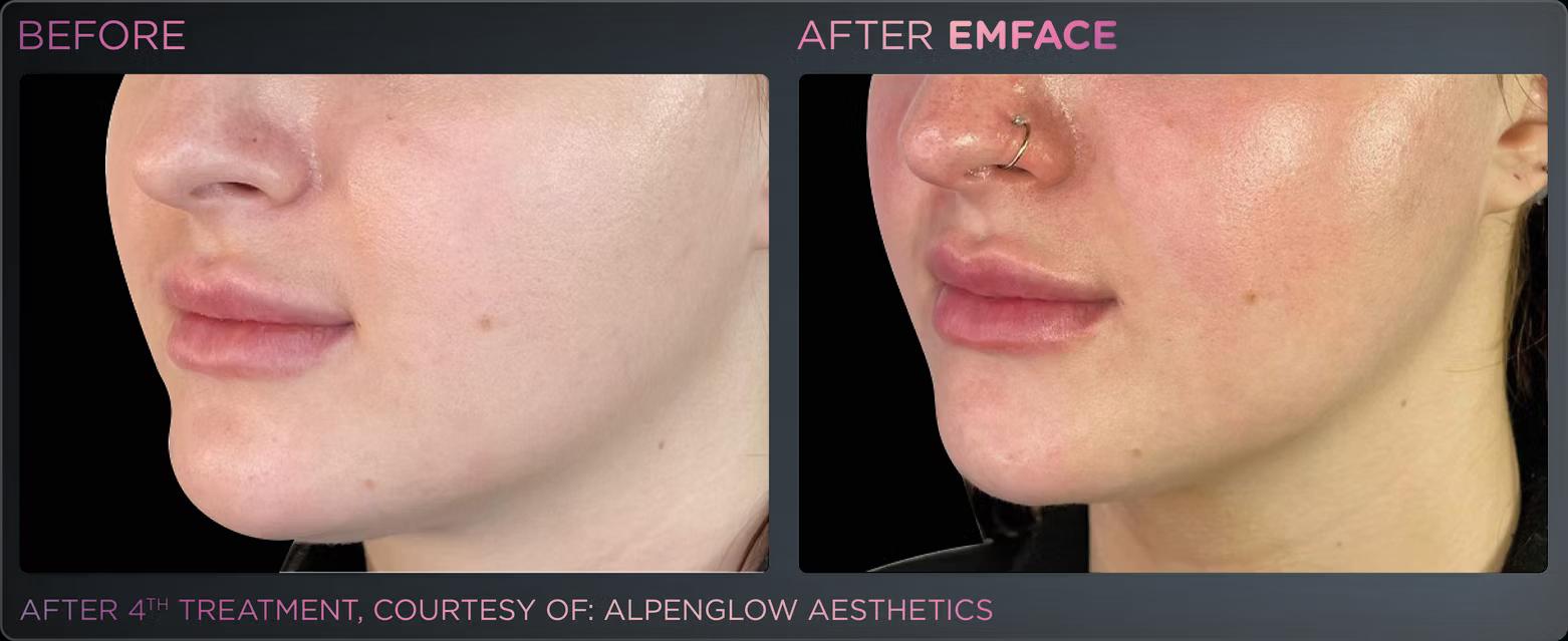 EMFACE before and after result 2