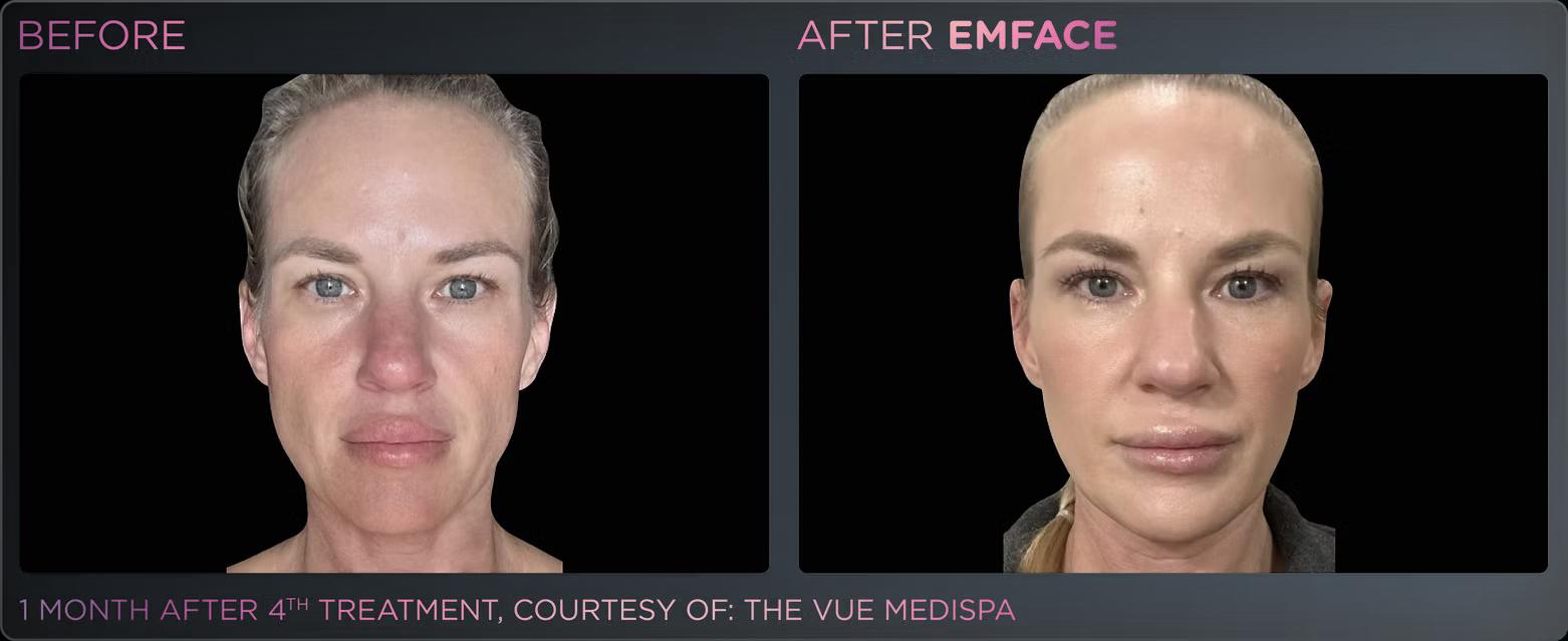 EMFACE before and after result 3