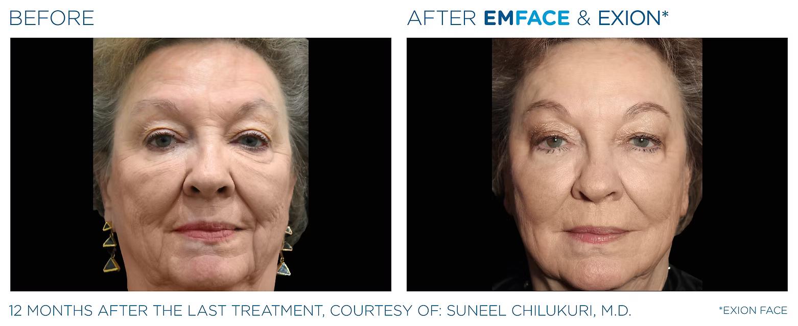 EMFACE before and after result 4