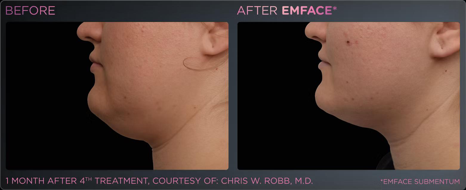 EMFACE before and after result 5