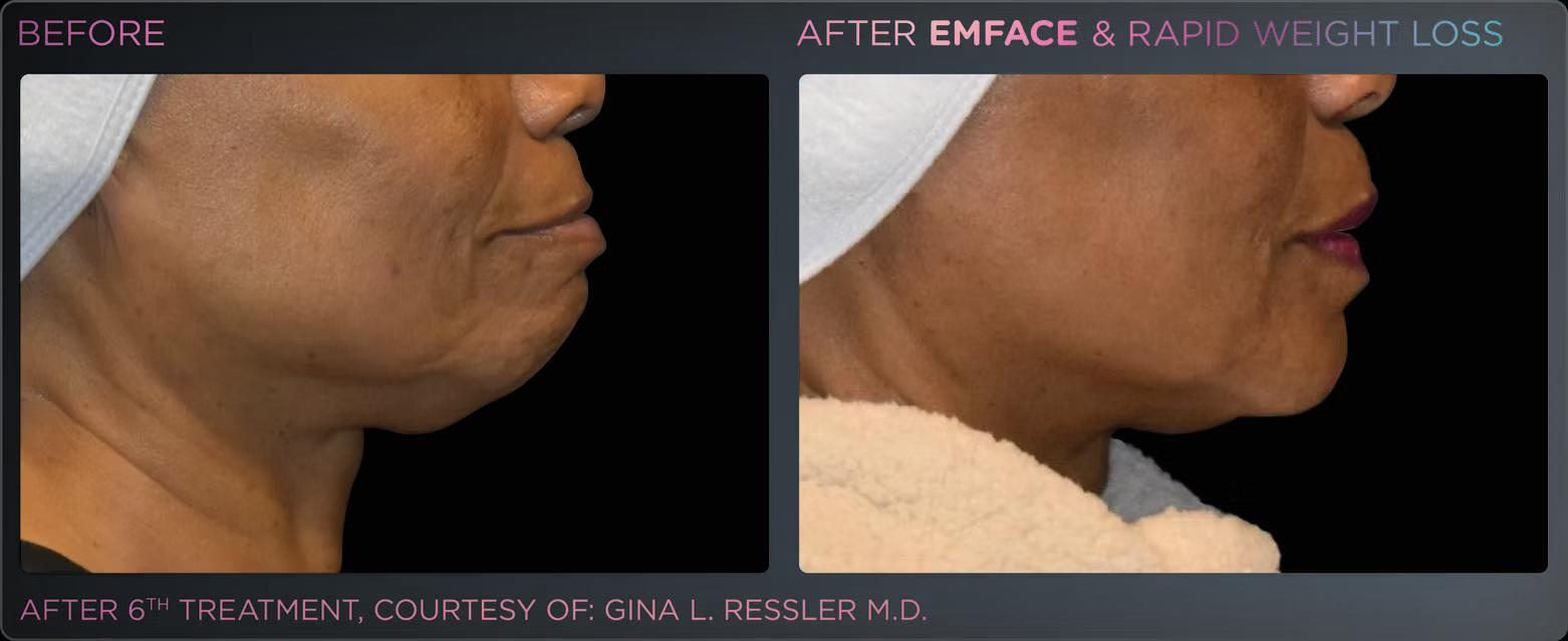 EMFACE before and after result 6