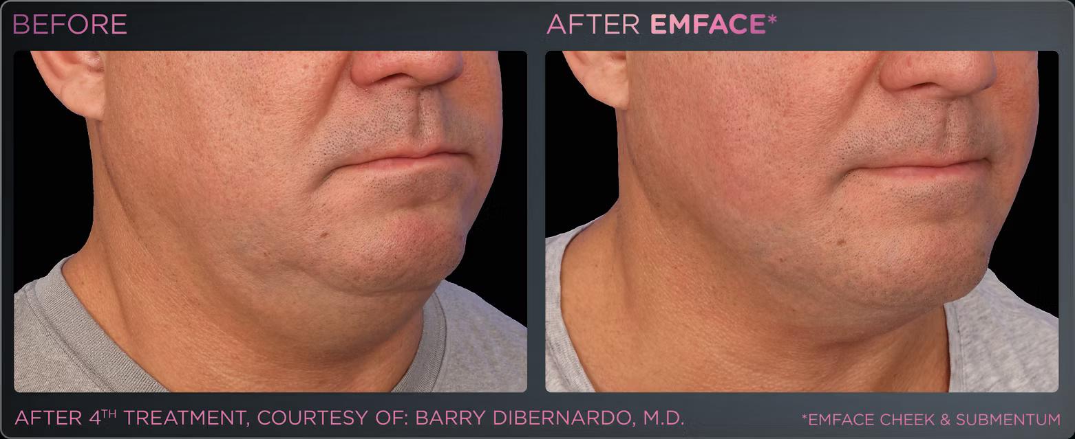 EMFACE before and after result 7