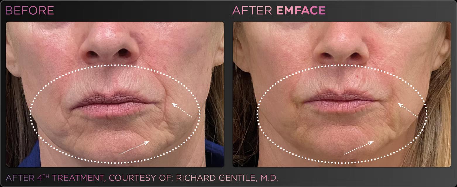 EMFACE before and after result 8