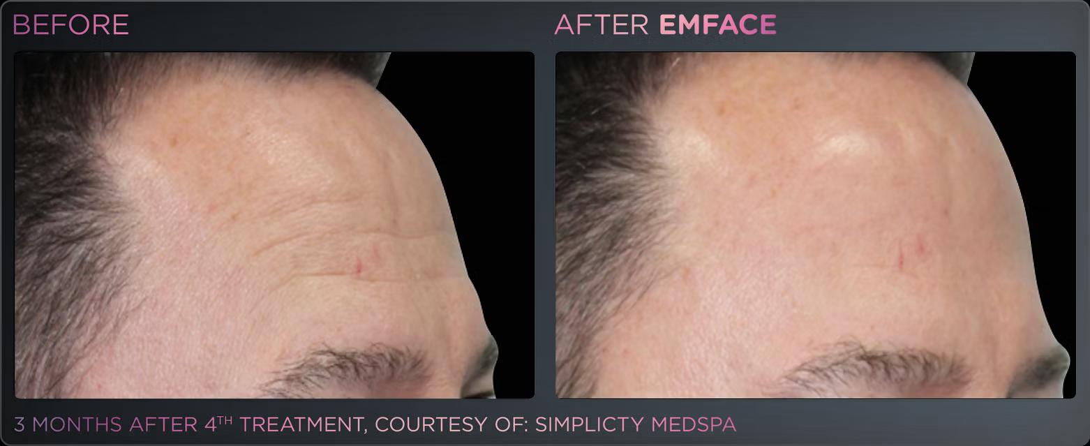 EMFACE before and after result 9