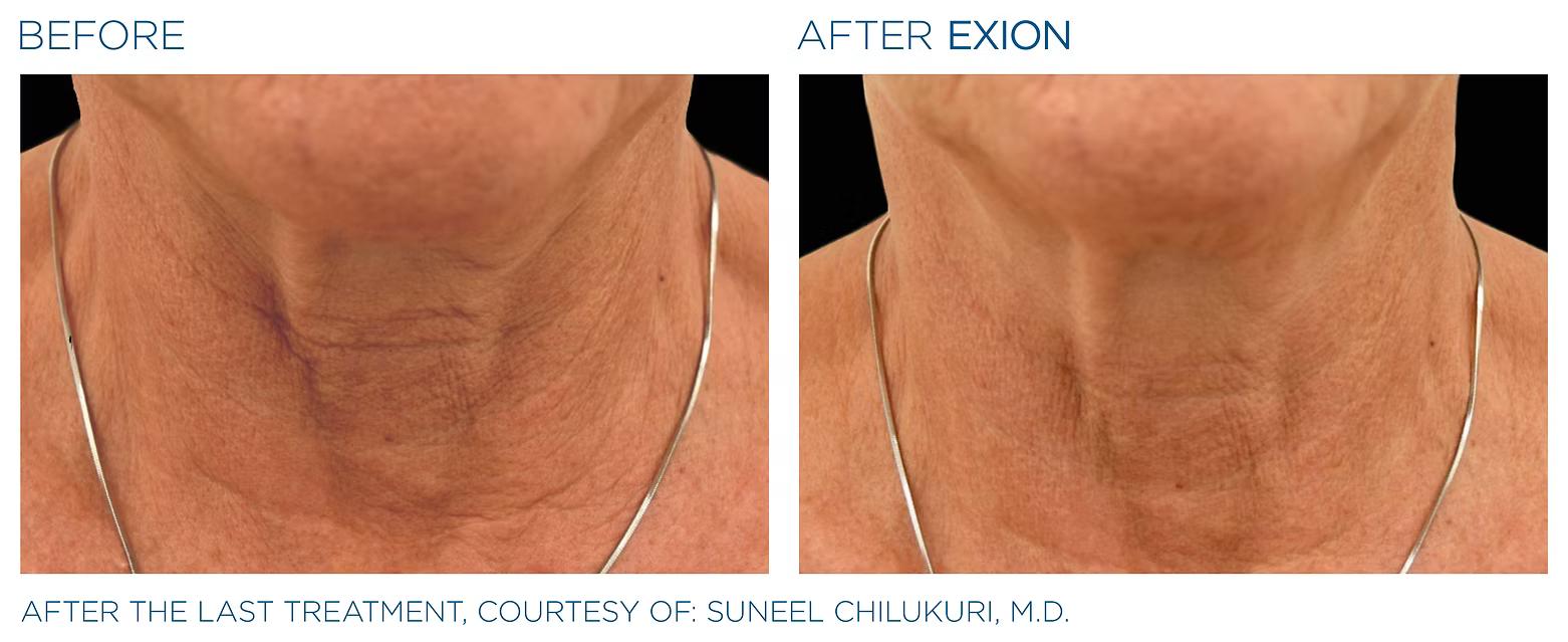 EXION before and after result 3