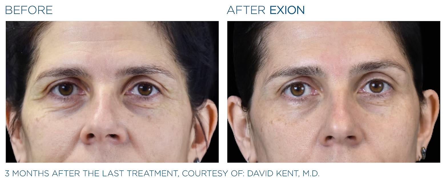 EXION before and after result 4