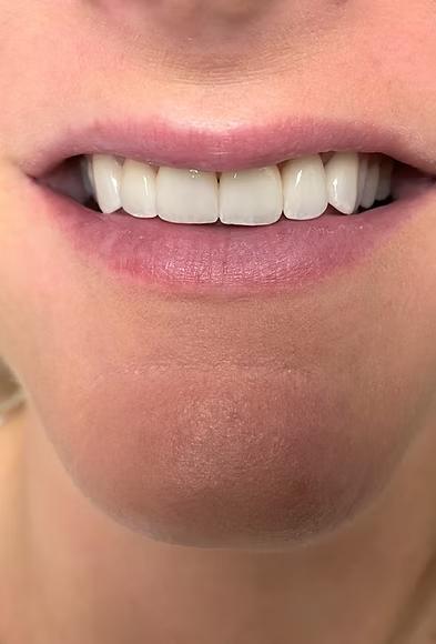 6-unit porcelain veneers smile transformation in Enumclaw WA
