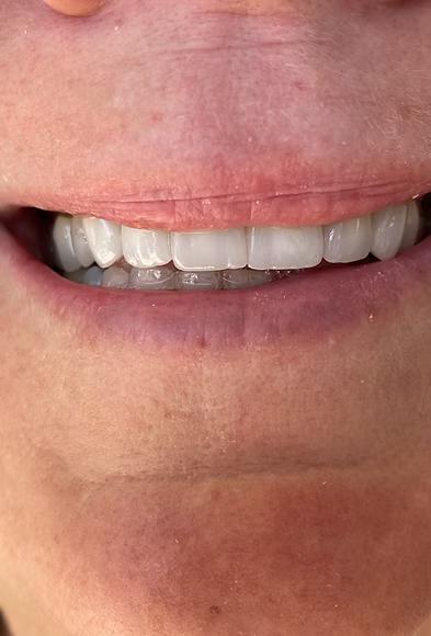 Porcelain veneers cosmetic dentistry result Enumclaw