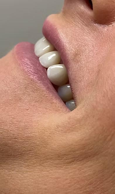 6-unit veneers smile transformation before and after