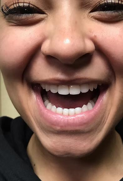 8-unit veneers smile makeover by Dr. Ossman