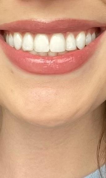 Composite veneers and teeth reshaping Enumclaw dentist