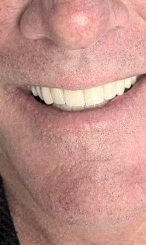 Full mouth crown and bridge restoration Enumclaw WA