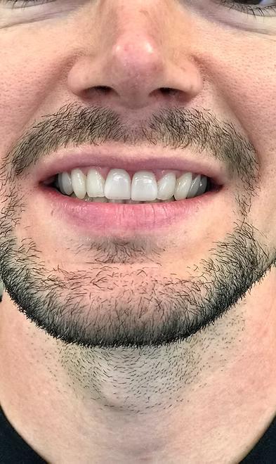 Single unit veneer cosmetic dentistry result