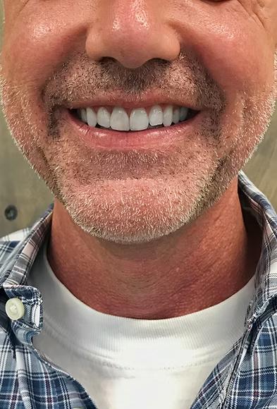 Single tooth veneer repair in Bonney Lake WA