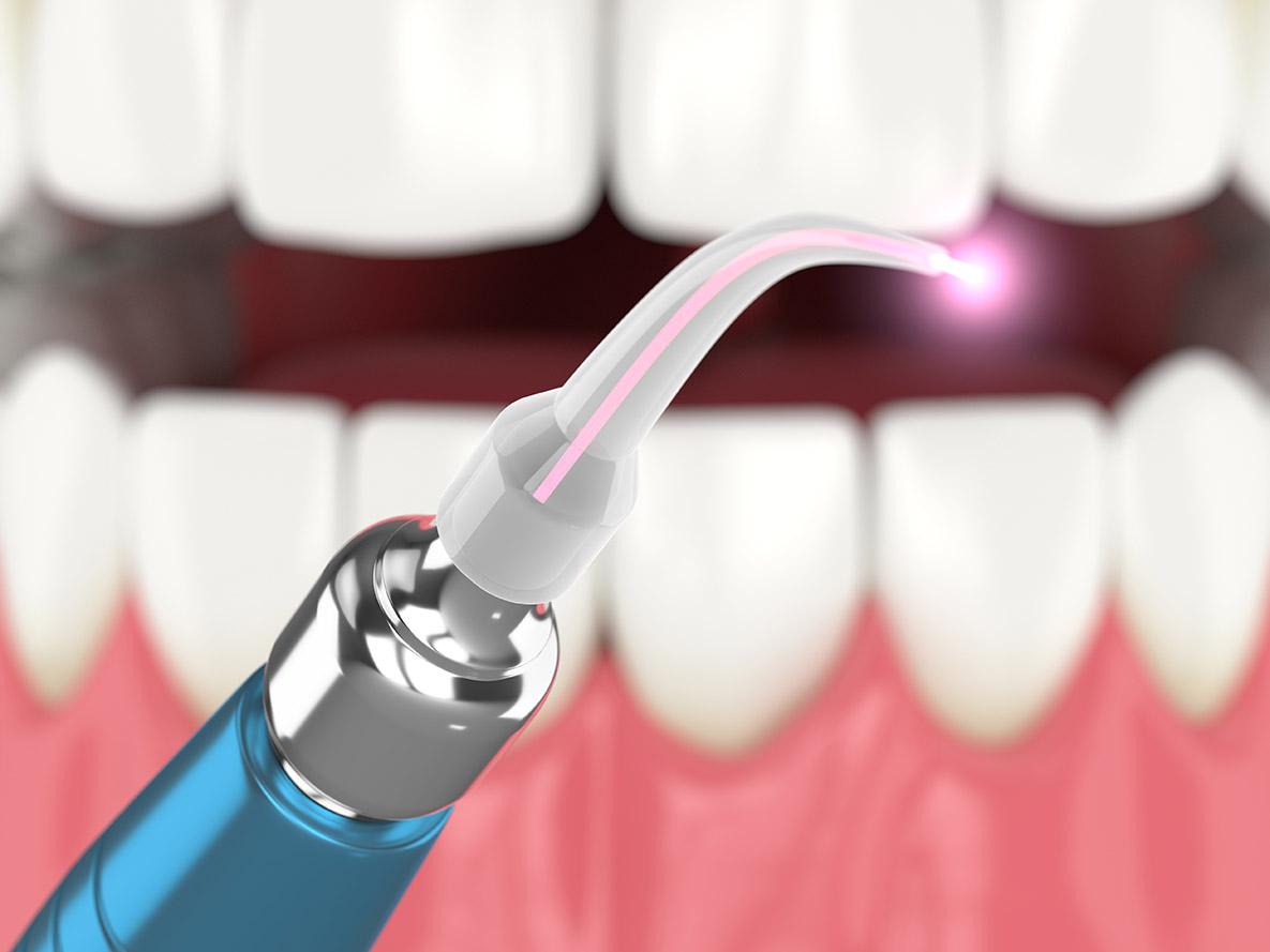 How Laser Dentistry Is Changing the Patient Experience
