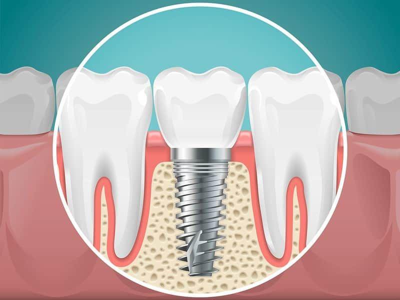 Dental Implants for Orting patients