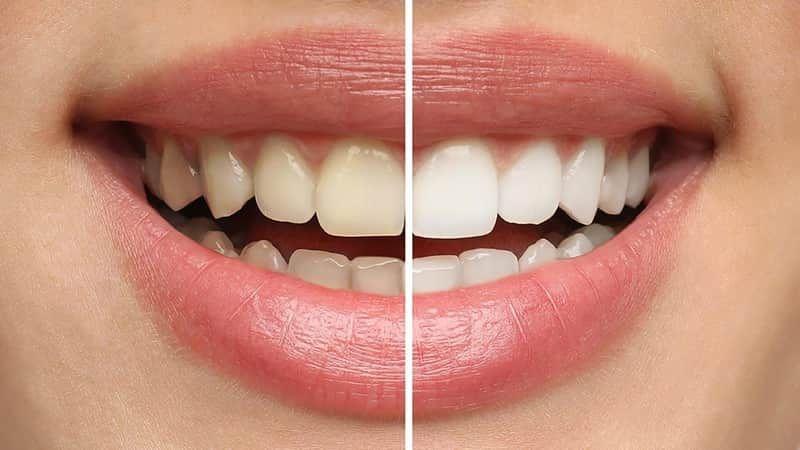 Teeth Whitening in Enumclaw