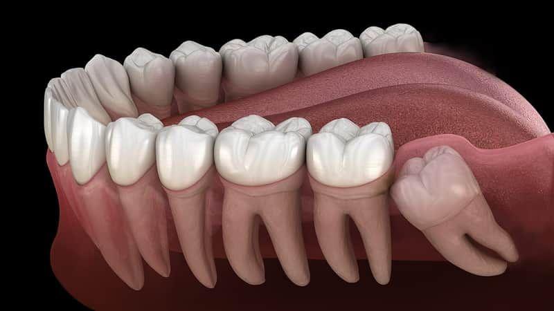 Wisdom Teeth Extraction for Orting patients